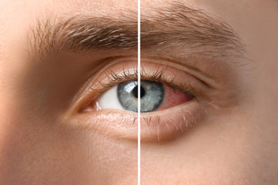 Types of Eye Emergencies